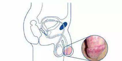 阴茎上长小疙瘩是什么病