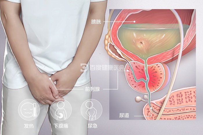 [男科问答]前列腺炎是什么？