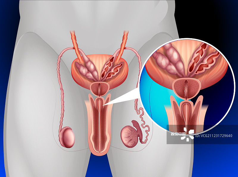 前列腺增生会导致腰疼吗