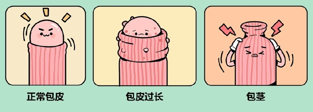 什么情况才算包皮包茎?割包皮去南京哪家男科医院?