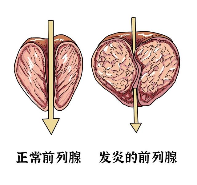 南京邦德医院解答：前列腺炎的危害有哪些？