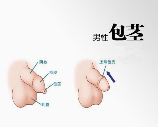 南京邦德男科医院解答：男性的包皮包茎具体存在哪些症状?