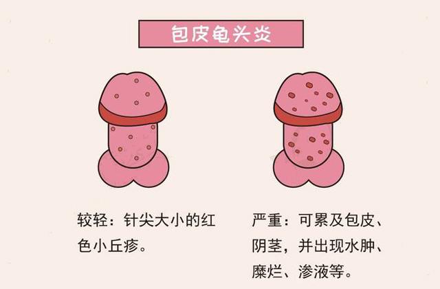 哪些症状属于包皮龟头炎?
