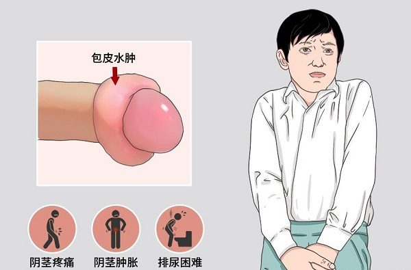 南京邦德中医院解答：男性出现包皮水肿怎么办