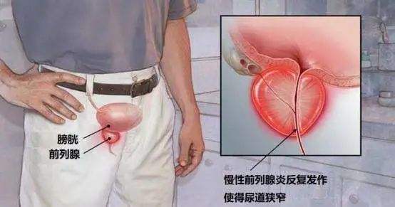 前列腺炎对人体有什么危害？