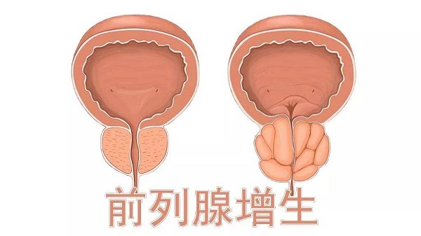 男性前列腺增生的病因有哪些呢?