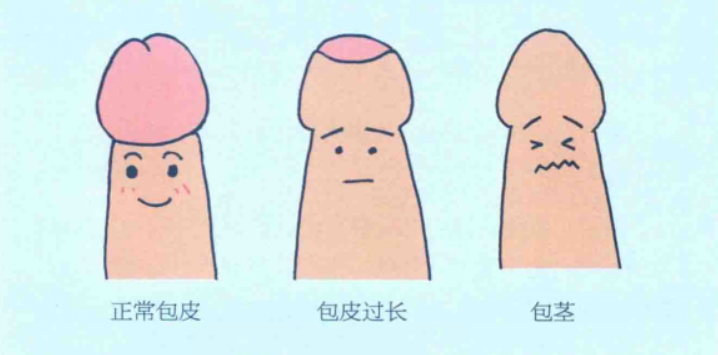 包皮包茎患者的症状都有些什么？